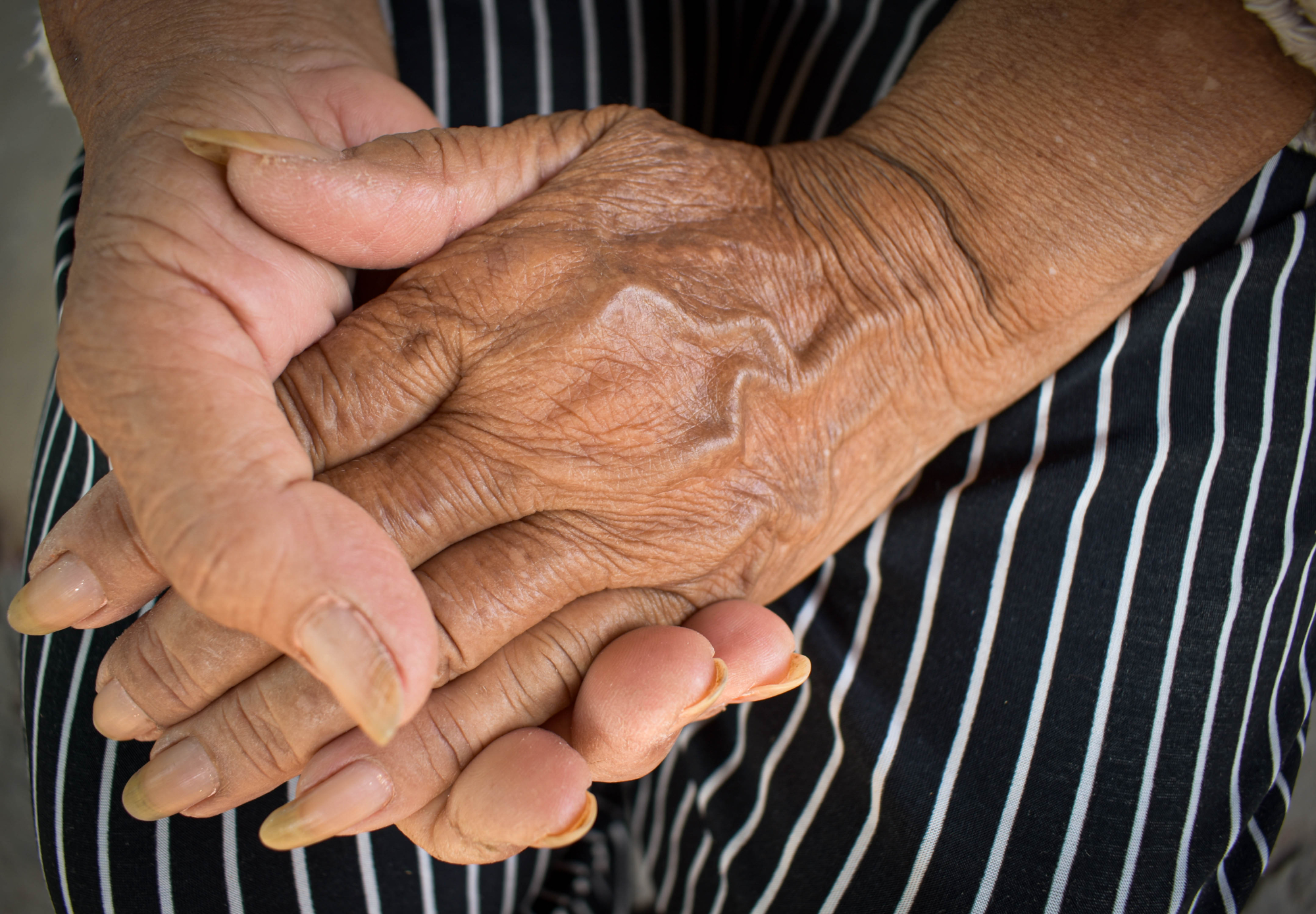 Zdravila, ki revmatoidni artritis ne zdravijo, ampak lajšajo in zavirajo