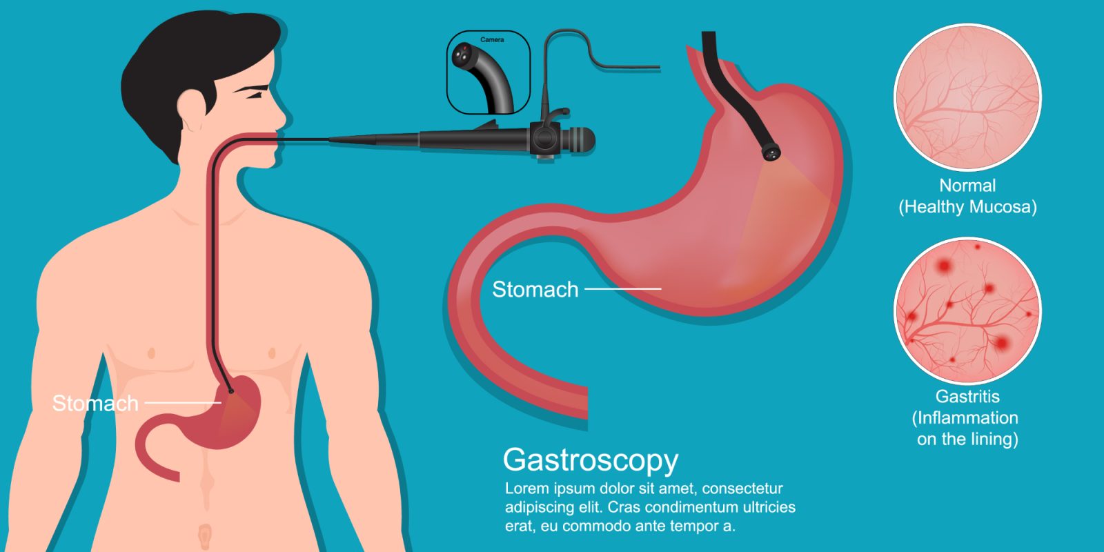 Gastroskopija je preprost, a izjemno natančen pregled zgornjega dela prebavil